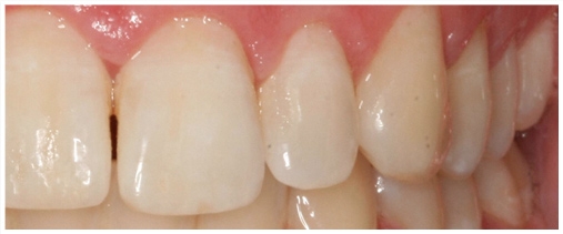 teeth_whitening_2.jpg