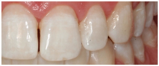 teeth_whitening_3.jpg