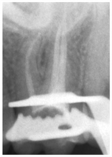 endodontic_2.jpg