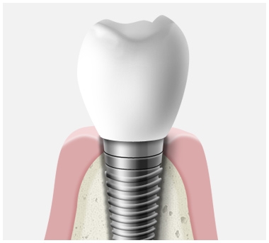 implants_1.jpg