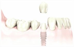 implants.jpg