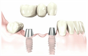 implants.jpg