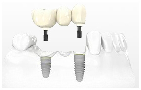 implants.jpg