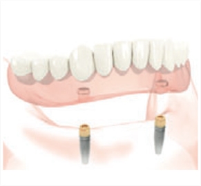 implants.jpg