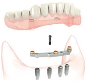 implants.jpg