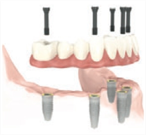 implants.jpg