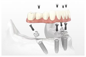 implants_8.jpg